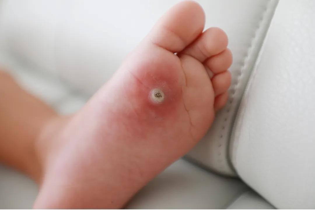 Close-up of a sole showing a rough, textured skin lesion with small dark pinpoint dots, a classic plantar wart